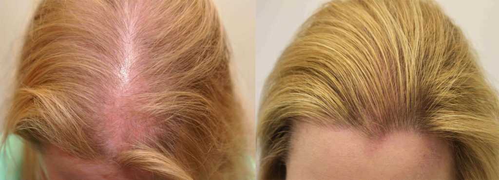 Как ускорить рост волос после ожога